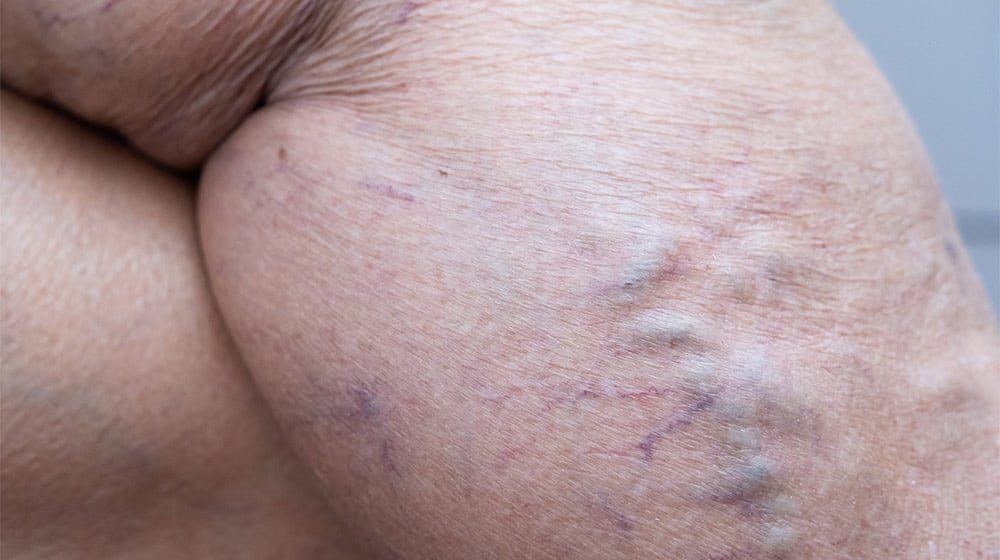 leg-with-vein-thrombosis-How-to-Treat-Venous-Reflux-Disease-ss-feat-prxh537wpjjjqdrn0a36mqj4245s9d8ktvma1cdfj4