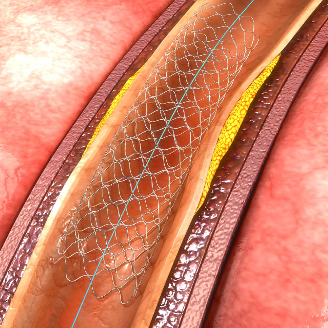 A stent is placed in an artery as part of a procedure called percutaneous coronary intervention PCI, also known as coronary angioplasty.